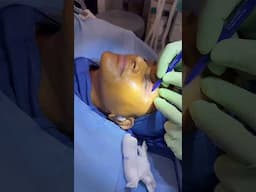Natural Rejuvenation Under Local Anesthesia — Eyelid Lift + Fat Transfer