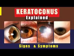 Keratoconus Explained: Signs, Symptoms & Why They Happen!