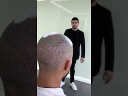 Hair Transplant Day 4: WASH DAY