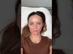 MICRONEEDLING 101: MY FACE AFTER #shorts