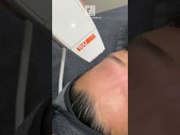 Clear your skin with our acne scar removal treatments! ✨