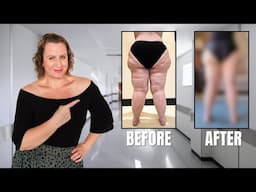 I Had Leg SURGERY (Lipedema - WAL Liposuction)