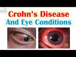 Crohn's Disease and Eye Conditions | 2 Important Eye Conditions in Crohn's