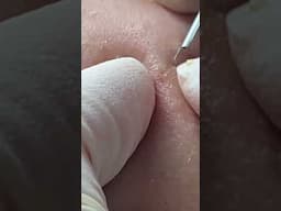 ACNE TREATMENT MAI NGỌC #acne #acnetreatments #blackheads #điềutrịmụnđànẵng #satisfying #điềutrịmụn