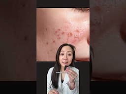 #skincare #skincareroutine #skincareproducts #acneproneskin #dermatologist