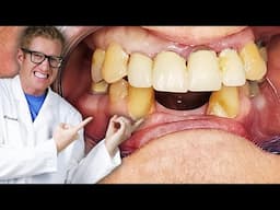 Dentist Does a DENTAL BRIDGE Procedure to Replace Lower Front Missing Teeth!!