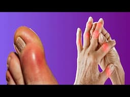 What Happens If Uric Acid Levels Are High?
