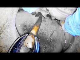 DENTIST EXTRACTS ALL UPPER TEETH DURING CRAZY IMMEDIATE DENTURE PROCEDURE!