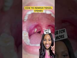 HOW TO REMOVE TONSIL STONES AT HOME 🦷 #shortsfeed #shortsvideo #shorts