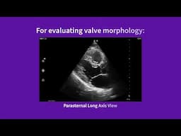 Vscan Air™ | Using presets for evaluations: valve morphology