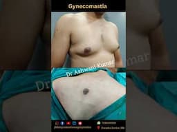 Gynecomastia Before & After  at BLINIQ by Dr Ashwani Kumar