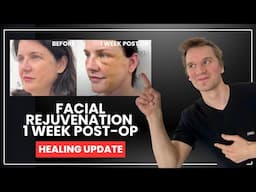 Facial Rejuvenation Journey: 1 Week Post-Op Deep Plane Facelift & more!