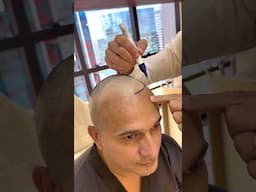 Hair transplant post-op: See the first results unfold! #vincihairclinic #shorts