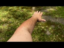 I Have An EXTREMERLY RARE Condition From Birth & I Didn't Even Know It (Radioulnar Synostosis)