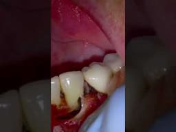 Filling On A Cavity Due To External Resorption! Small Surgery To Fill the Tooth.