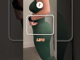 Lipo or Natural? Take a Guess! #liposuction