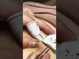 1 Minute Of Top ASMR Pimple Popping Video №100