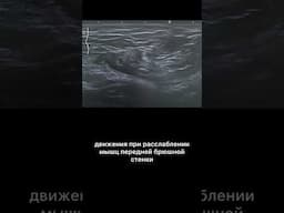 #узи #паховаягрыжа