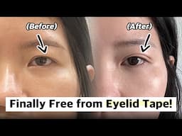 Eyelid Transformation: From Droopy to Dreamy!
