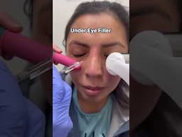 New nose in 15 minutes: no surgery
