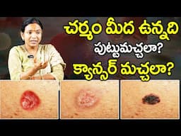 చర్మం మీద ఉన్నది పుట్టుమచ్చలా..? క్యాన్సర్ మచ్చలా..? Dr Geetha || Skin Cancer || SumanTv Health