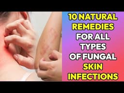10 Natural Remedies for Fungal Infection on Skin (Tinea, Ringworm, Yeast infection, Private parts)