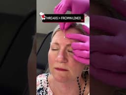Threads For Frown Lines