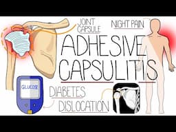 Adhesive Capsulitis (Frozen Shoulder Explained)