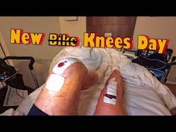 What to expect with Double Knee Replacement Surgery