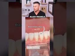 Dentist Reveals How They Fix The DREADED Black Triangles! 😭🦷