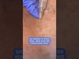 Make Spider Veins Disappear!