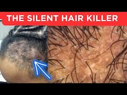 Hormones Are Hijacking Your Hairline!