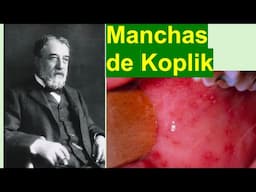 Manchas de Koplik