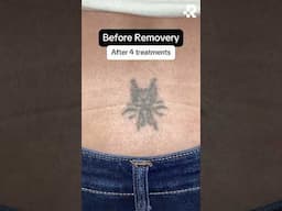 Tattoo removal transformation #removery #tattooremoval