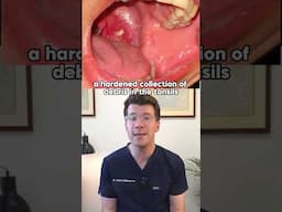 Doctor explains Tonsil Stones #shorts