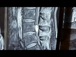 Spinal tumour Schwannoma, Neurofibroma : what is it & how to treat it ?​⁠@Sanchetispinepune #pune