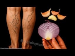 You’ll NEVER Believe What Erased My Varicose Veins! 🤯 2 Home Remedies