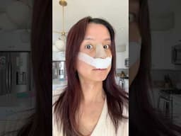 1 year later nose job reveal!