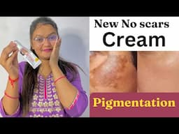 New* No scars Cream | सबसे अच्छी क्रीम pigmentation के लिए