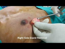 Grade 1 Gynecomastia Surgery Under Local Anaesthesia | No Liposuction | BLINIQ Cosmetic Surgery