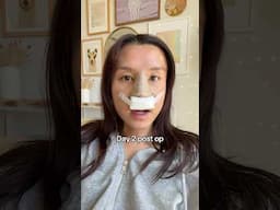1 year nose job journey!