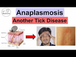 Anaplasmosis: A Tick Infection You Might Not Know You Have (Symptoms, Diagnosis, Treatment)