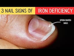 3 Nail Signs Of Iron Deficiency Anemia