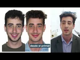 Cirugía bimaxilar Caso #156: Eduard - Clase II, retrusión maxilo-mandibular, mordida abierta