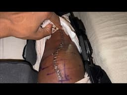 Tibial Tubercle Osteotomy and Cartilage Autograft Knee surgery | update 1