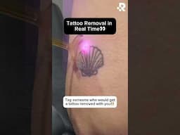 Tattoo removal in real time👀 #removery #tattooremoval