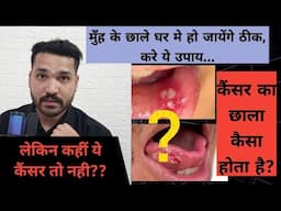 मुँह के छालो के 4 घरेलू ईलाज!  कैसा मुँह का छाला कैंसर हो सकता है ?