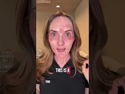 Lower bleph without surgery!? Yes! Today I did a full lower #blepharoplasty with my plasma pen!