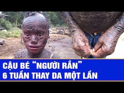 Cậu bé “người rắn”, 6 tuần thay da một lần | Chuyên động 24h