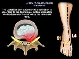 Sciatica or Lumbar Spinal Stenosis: symptoms, diagnosis, and treatment.